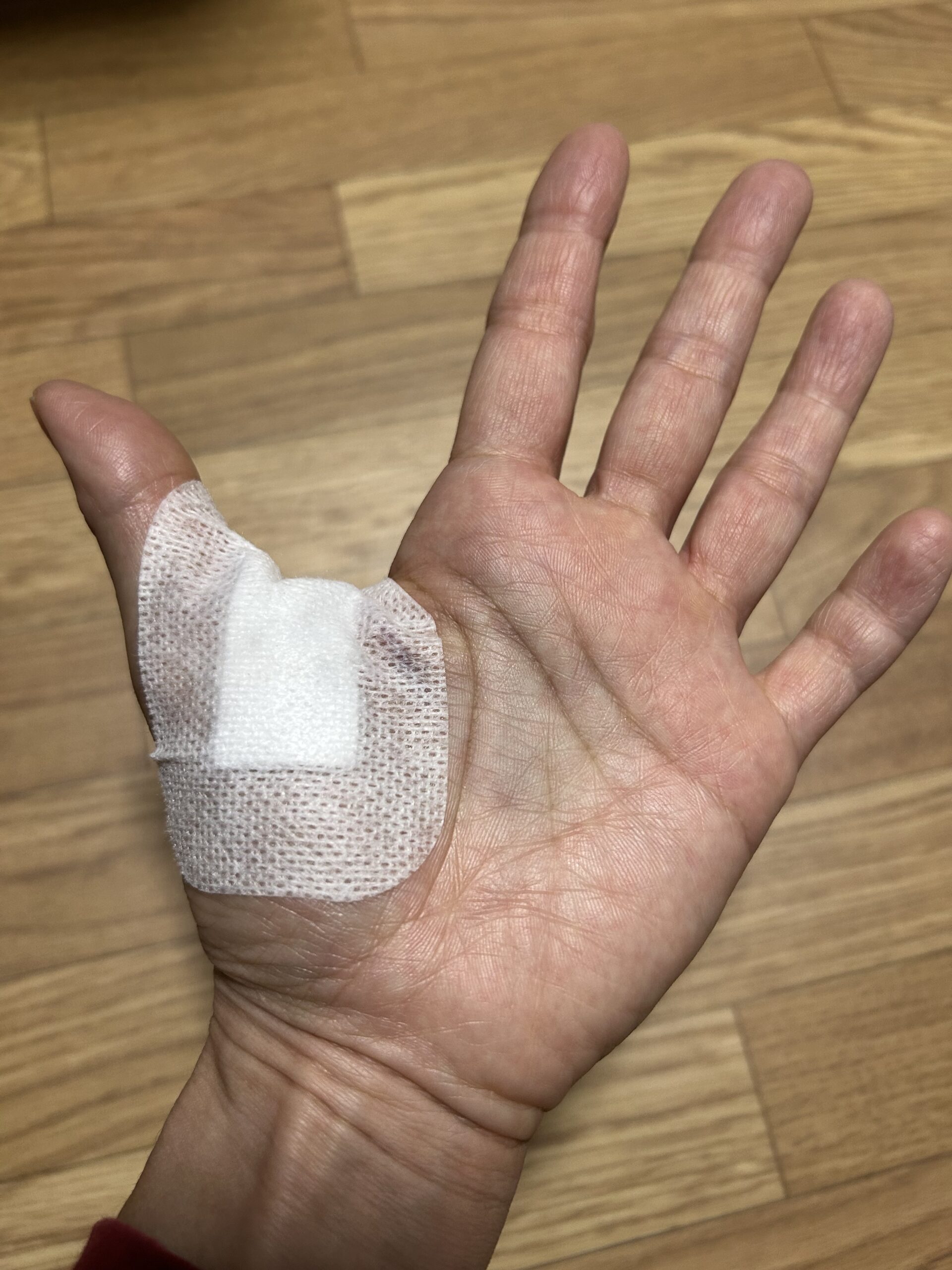 ばね指の手術③（手術翌日～抜糸）